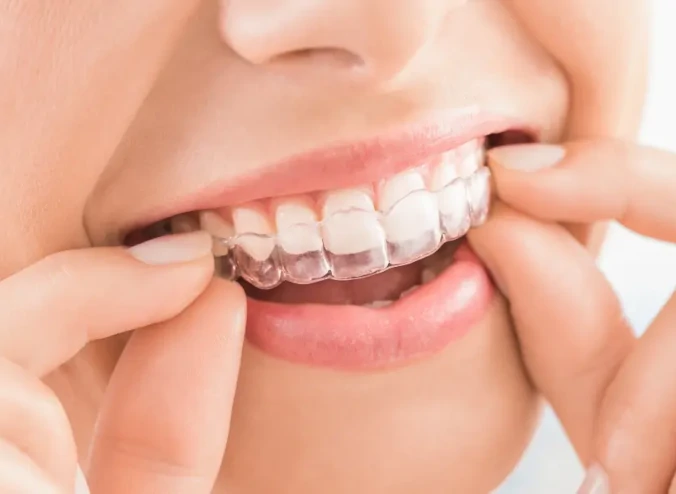 Platinum Dentistry_braces-1